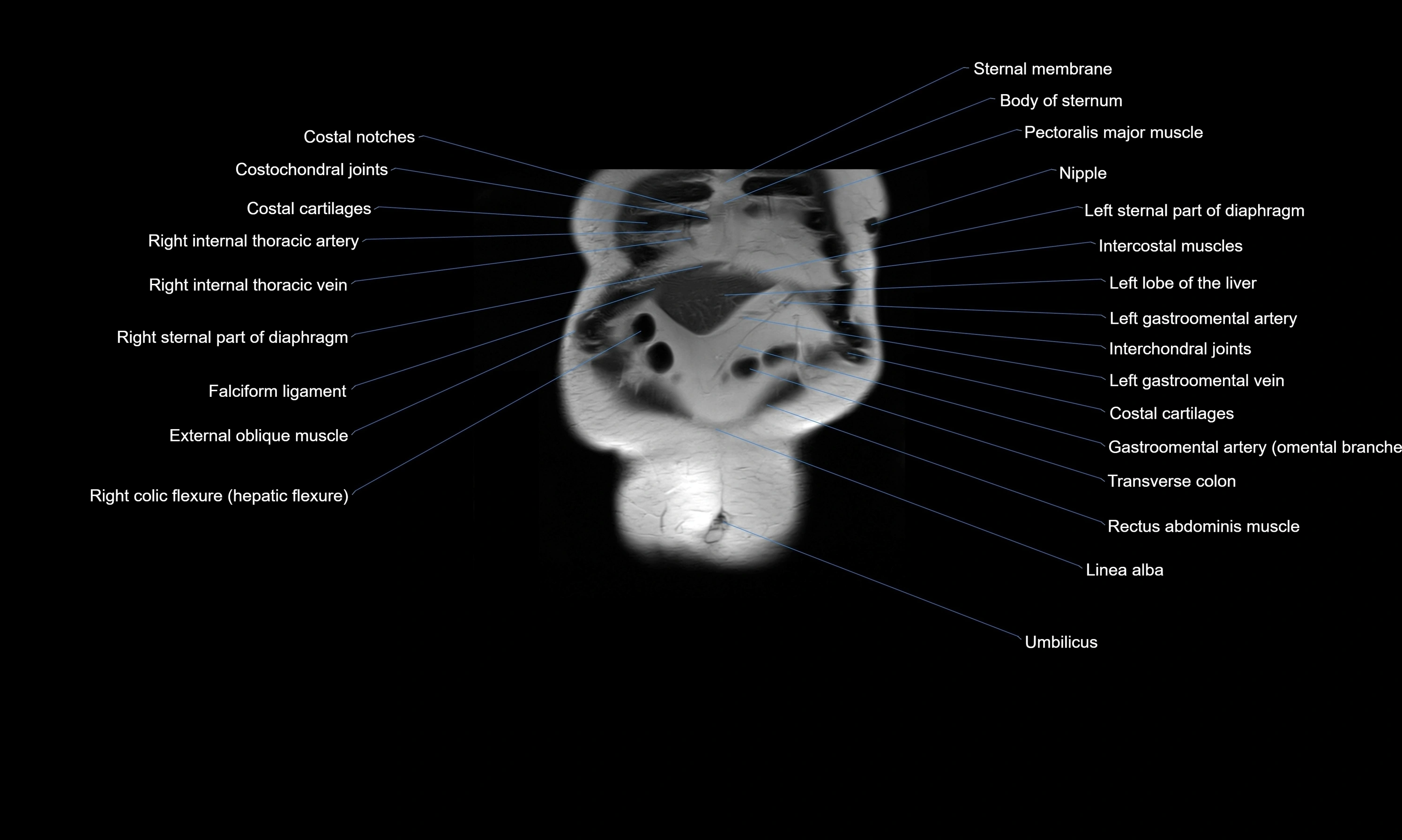 MRI Abdomen axial cross sectional anatomy radiology  image-img-00001-00008.webp
